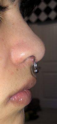 Incorrectly placed septum piercing that is extremely low ON MY CARTILAGE...