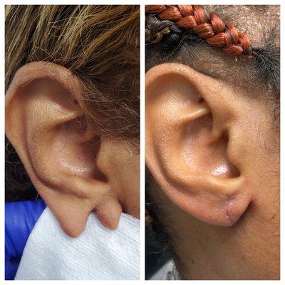 Ear Lobe Repair