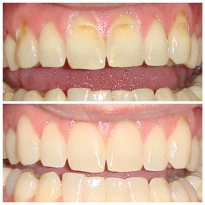 Non-invasive cosmetic bonding. Treatment of enamel erosion.