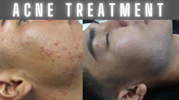 Acne Treatment for men