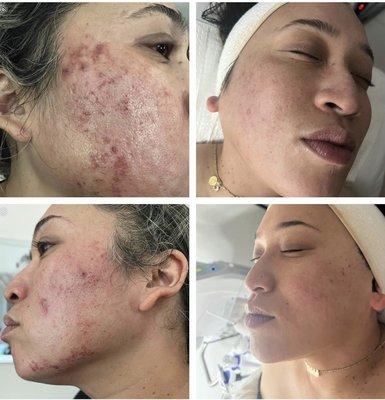 Before and After Acne Treatment