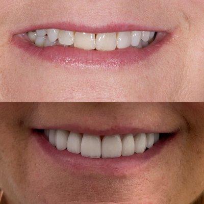 10 veneers to help with the cracked teeth and to give a natural aesthetic smile