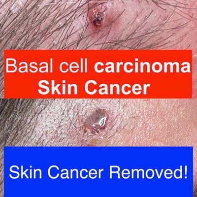 Basal Cell Carcinoma Skin Cancer Doctor Yun Removed From Me.