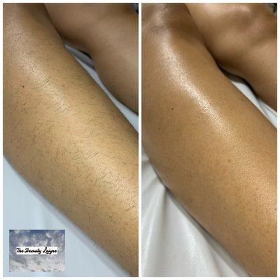 Leg hair removal using only Sugar