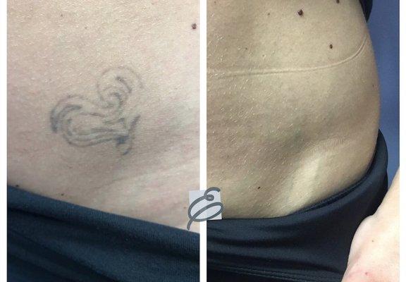 Laser tattoo removal