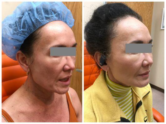 YLift two weeks post treatment by Yung Chen, MD