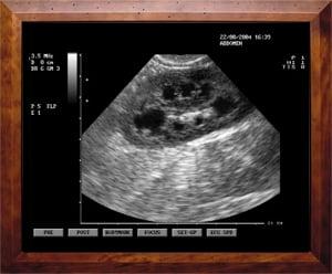 Ultrasound