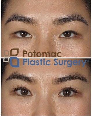 Upper eyelid surgery by Dr. Chaboki of Potomac Plastic Surgery DC