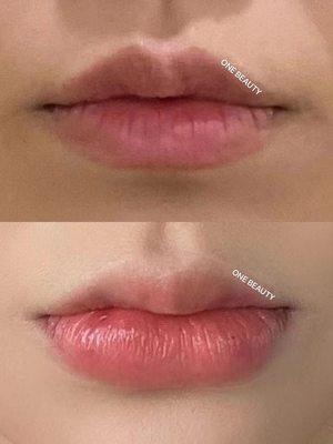 Lip Filling