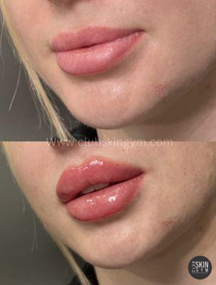 Pillow Lips Package