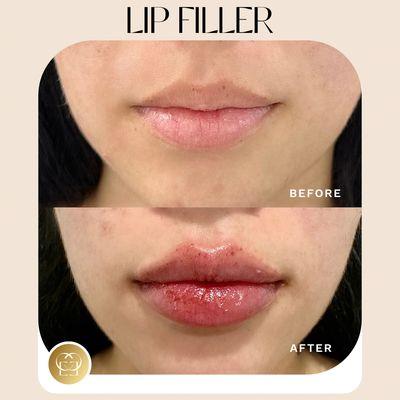 Lip filler