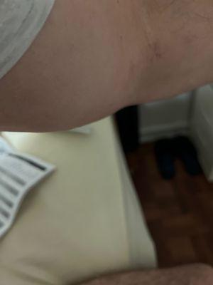 A contrast of a metal toxin , that swollen in my arm