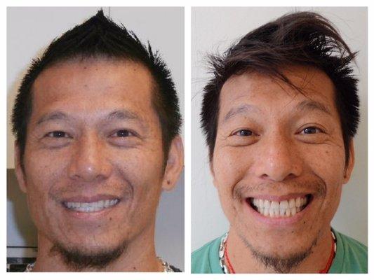 invisalign before & after