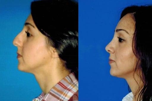 An example of one of the many rhinoplasties performed by Dr. Cher that produce beautiful and natural looking results