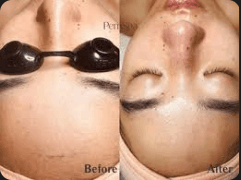 Facial