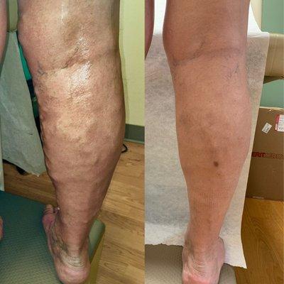 Endovenous laser Vein Treatment (before, and after)