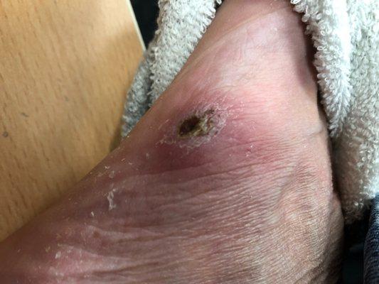 Infected foot after a Cali Nails pedicure