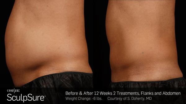 Before and After SculpSure Laser Fat Removal Treatment