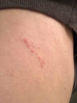 Bed bug bites