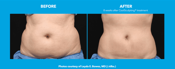 CoolSculpting