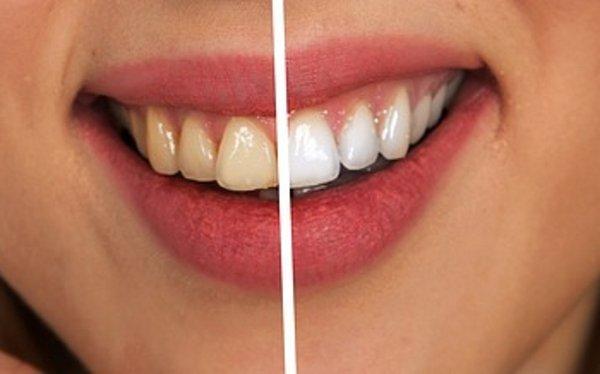 Teeth Whitening