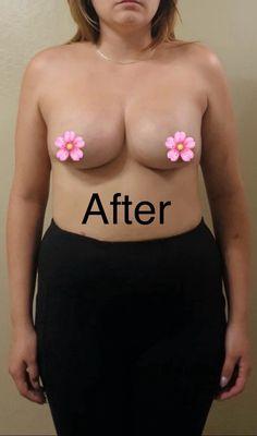 After breast augmentation