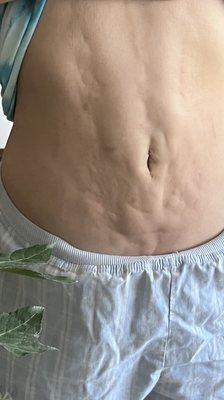 One year lipo results