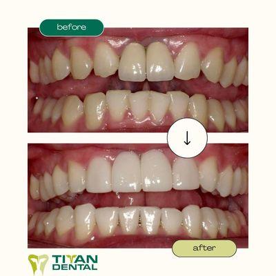 Cosmetic Dentistry #TitanDental