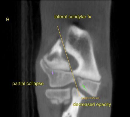 Our onsite CT provides the gold standard for imaging elbow fractures for young patients