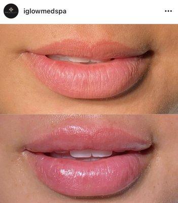 iGlowMedSpa Porter Ranch - Lip Injections Restylane Kysse