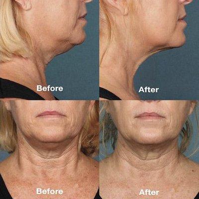 [Kybella] - Before and After treatment. DermLA.com