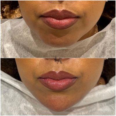 Chin augmentation with fillers