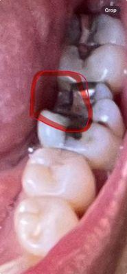 Molar broke off ...