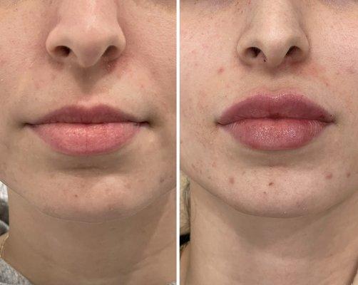 Lip augmentation by Nurse Alyssa