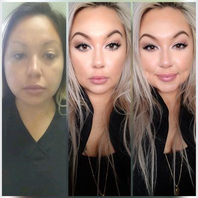 Timeless Dimpleplasty before and after