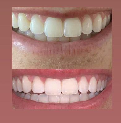 Organic teeth whitening