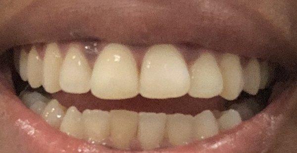 My teeth the day my braces came off ! PATHETIC ! & y'all got attitudes & shit with me because I'm wanting a FAIR SOLUTION! The audacity !