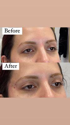 Non-surgical Brow lift