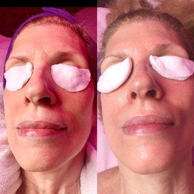 Microdermabrasion chemical peel before and after