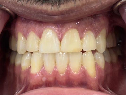 * #TeethWhiteningResults
 * #BrighterSmile
 * #BeforeAndAfter
 * #WhiteningTreatment
 * #WhitenedTeeth