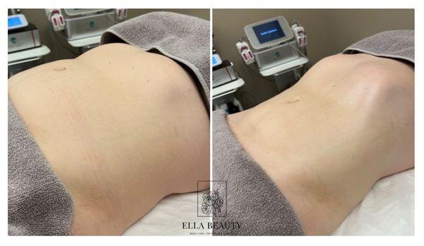 Before and *immediately after* one session of BLD, Ella's signature treatment.