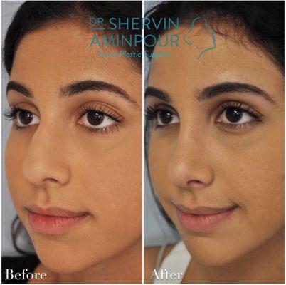 With this delicate change, the patient feels more beautiful as her eyes and lips are no longer overshadowed by her nose.