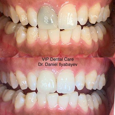 Internal tooth whitening and Porcelain crown 718 575-0060 Dr. Daniel Ilyabayev