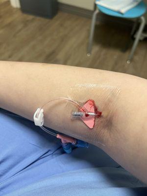 After 5 pokes, this is the best they could do. I'm sure I'll be charged for the IV bag too.