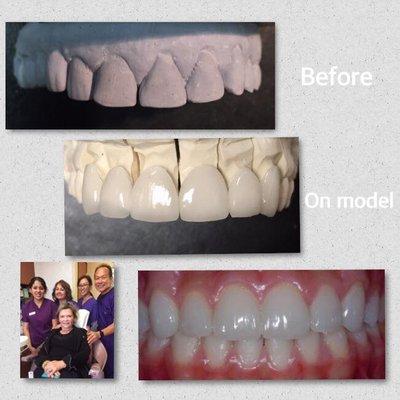 Porcelain Veneers! She requested smooth, glistening, symmetrical, and non bulky veneers. Check out 100's of cosmetic work on my FACEBOOK pg!