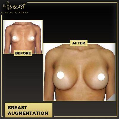 Breast Augmentation Miami - The Secret Plastic Surgery