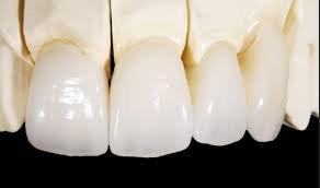 All Ceramic Crowns