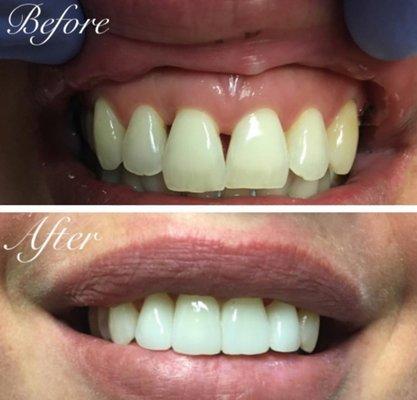 before & after - female smile