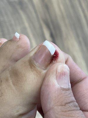 The nail injury , from your neglectful nail tech who didn't even ask if I wanted to ingrown mail cut they always ask first he just did it .