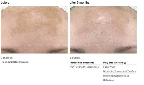 Before and after: Hyperpigmentation treated using the PCA Peel with Hydroquinone